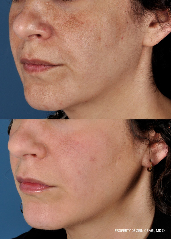 ZO Facial Peel Before and After| The Listening Doctor