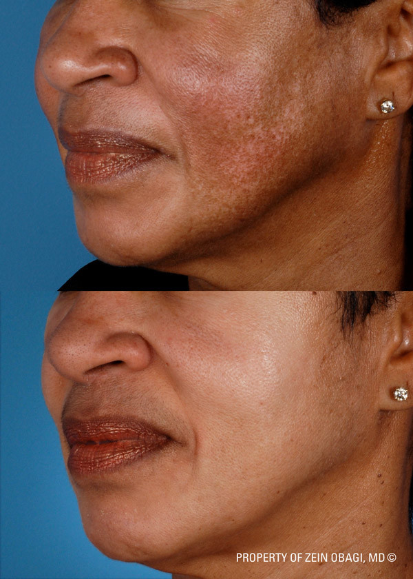 ZO Facial Peel Before and After| The Listening Doctor
